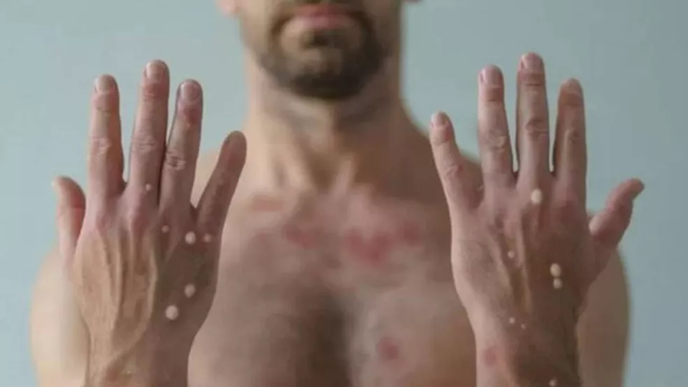 Bauru confirma primeiro caso de varíola dos macacos