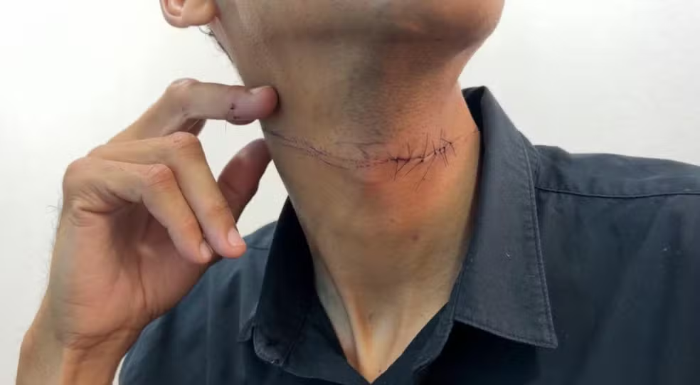 Motociclista recebe pontos no pescoço ao ser atingido por linha chilena no interior de SP